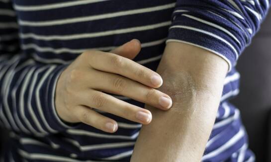 Kiedy stosować maści bez recepty na swędzenie skóry przy świerzbie?