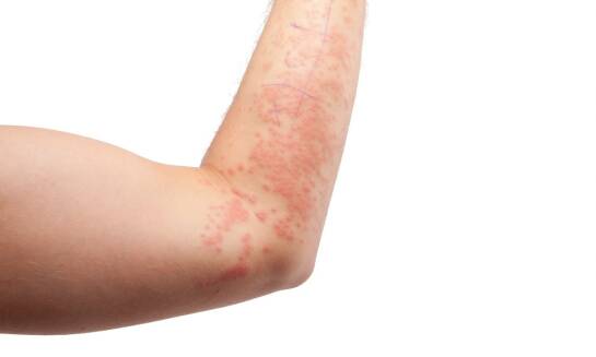 Zmiany skórne a ogólne zdrowie - co mogą sygnalizować problemy ze skórą?