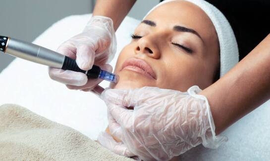 Zalety mikroigłowej radiofrekwencji w kontekście redukcji przebarwień na twarzy