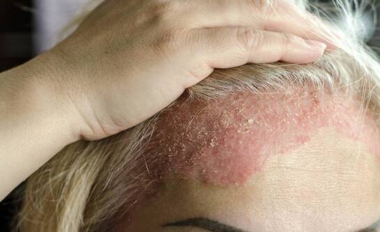 Ospa wietrzna – co to jest i jakie są jej objawy?