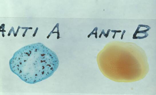 Co oznacza grupa krwi 0 Rh+?