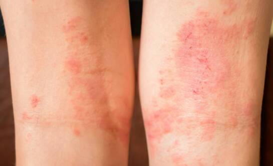 Ospa u dzieci – jak postępować w przypadku zachorowania