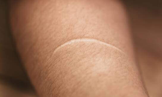 W jaki sposób hirudoterapia może pomóc przy redukcji stanów zapalnych?