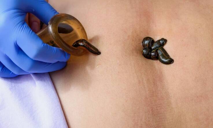 Znaczenie hirudoterapii w profilaktyce przewlekłych schorzeń