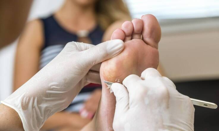 Znaczenie edukacji pacjentów w profilaktyce i leczeniu odcisków z korzeniami