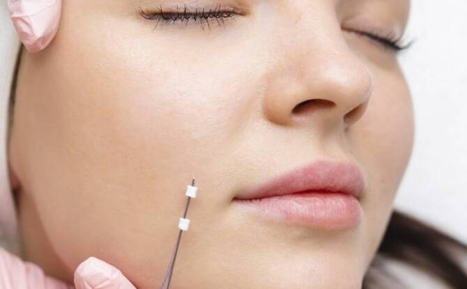 Wpływ Dermapen na redukcję drobnych mimicznych zmarszczek