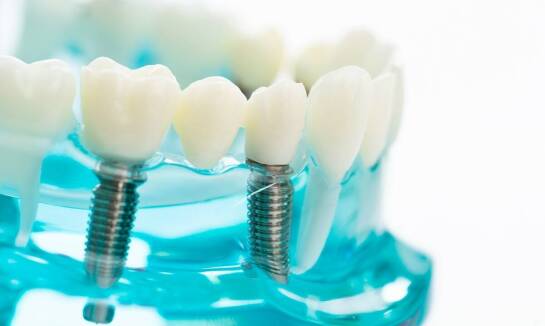 Czym różnią się różne rodzaje zębowych implantów?