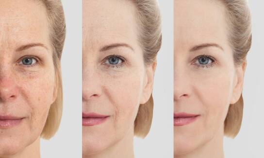 Jakie efekty można uzyskać po serii zabiegów z frakcyjnym laserem?