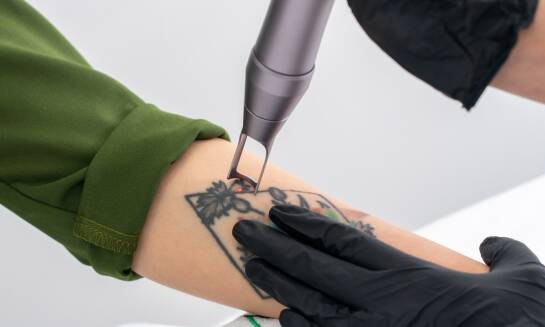Laserowe usuwanie tatuażu: jak skóra reaguje i kiedy planować kolejną sesję