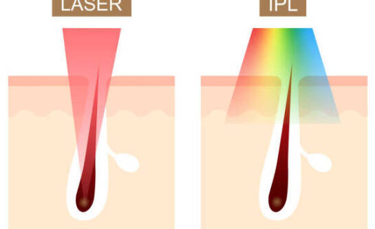 Dlaczego depilacja laserowa działa etapami, a włosy trzeba usuwać w serii zabiegów