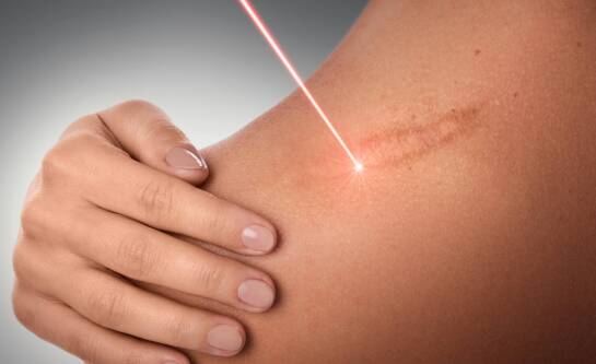 Laserowe usuwanie blizn i przebarwień – co warto wiedzieć?