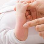 Objawy uczulenia na białko u dzieci.