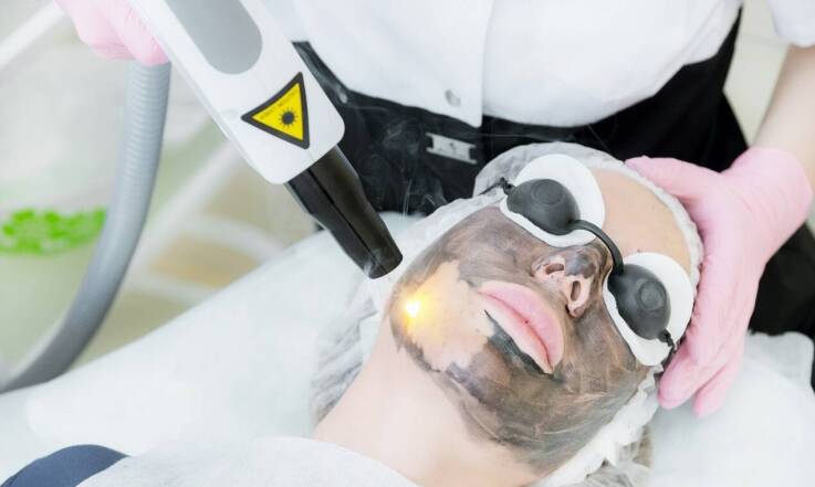 Oczyszczanie skóry laserem. Jakie efekty przynosi peeling laserowy?