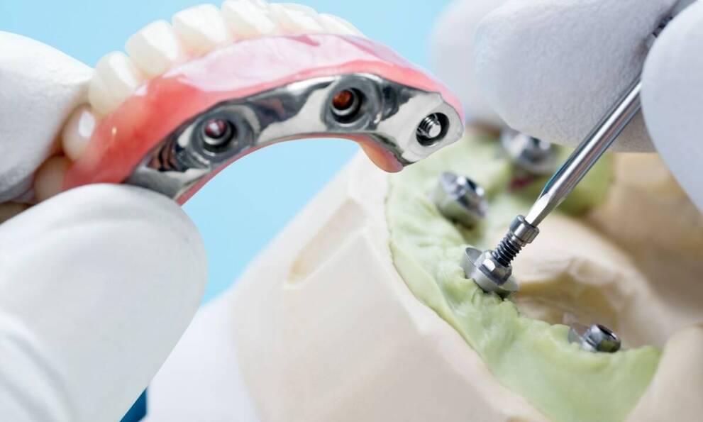 Od czego zależą ceny implantów zębowych?