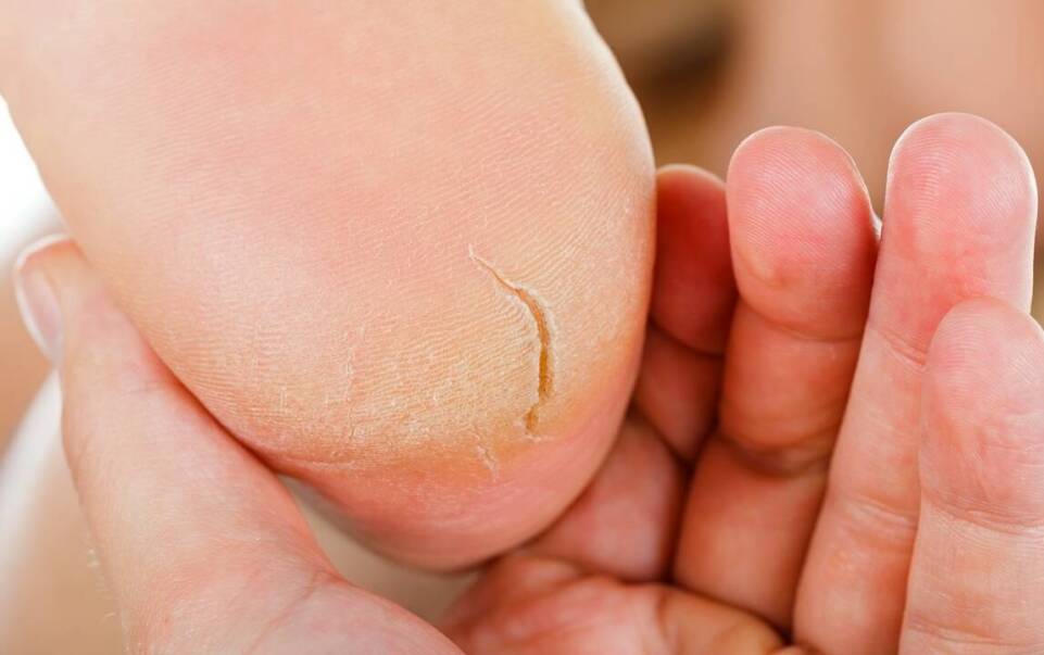 Leczenie pękających pięt u diabetyków - jakie zabiegi są zalecane?