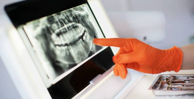 Rola diagnostyki RTG w procesie leczenia kanałowego