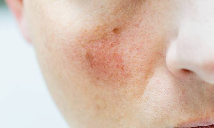 Jakie są typowe objawy świerzbowca u dzieci, które mogą zaskoczyć rodziców?