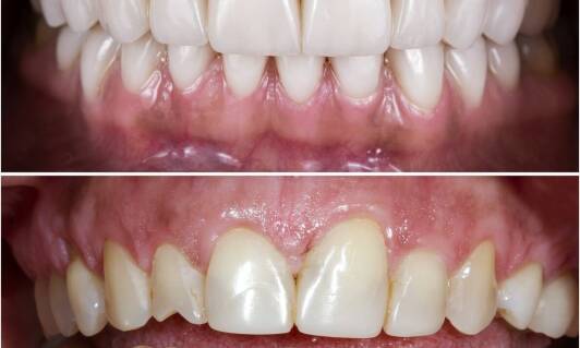 Jakie są zalety pełnych rekonstrukcji zwarcia w stomatologii?