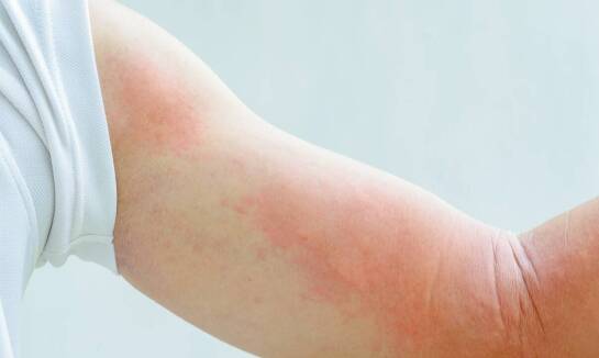 Zmiany skórne u dzieci – kiedy zgłosić się do dermatologa?