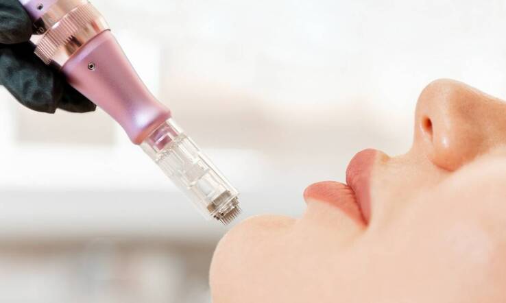 Hyaluron Pen jako sposób na naturalny efekt odmłodzenia skóry