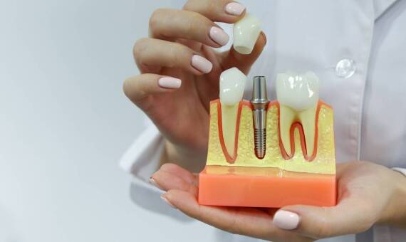 Rodzaje implantów zębowych – czym się różnią?