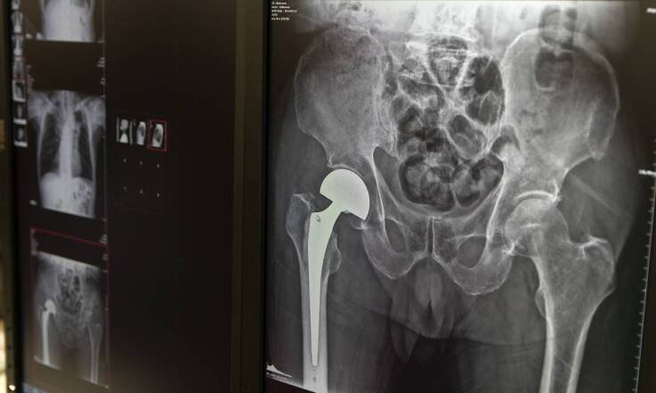 Jakie materiały stosuje się w endoprotezach biodra i jakie mają zalety?