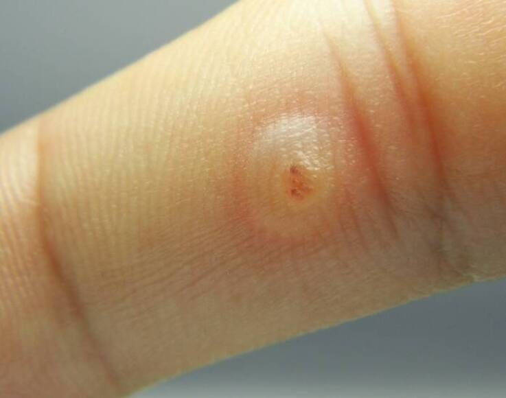 Czym są kurzajki i jakie są przyczyny ich powstawania?