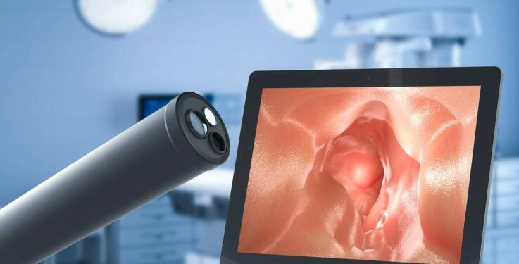 Jakie są zalety nieoperacyjnego leczenia hemoroidów za pomocą endoskopii?