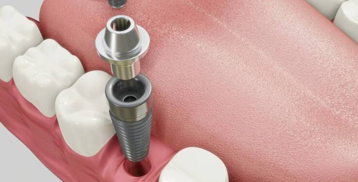 Zastosowanie implantów zębowych w odbudowie pełnego uzębienia