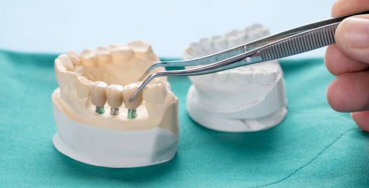 Jak długo trwa proces wstawiania implantów?