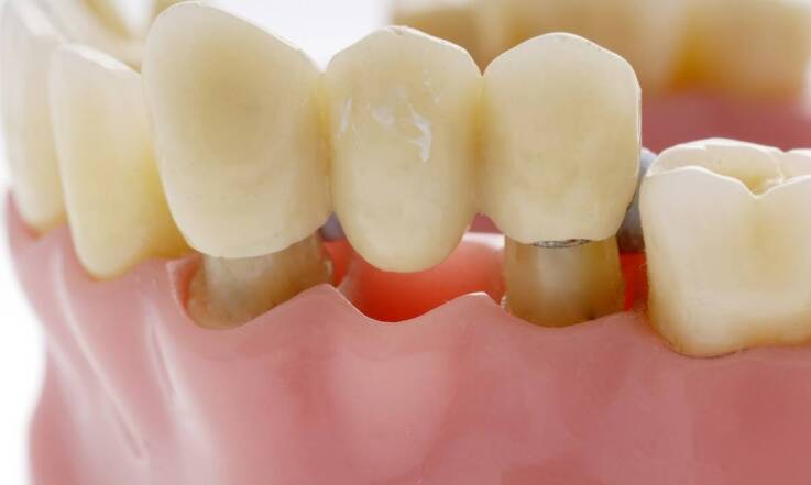 Jakie są możliwości odbudowy zębów z użyciem koron i mostów u dentysty w Poznaniu?