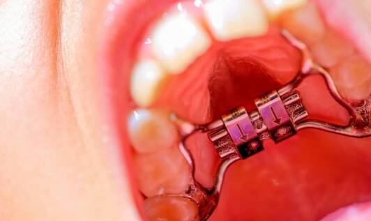 Jakie czynniki wpływają na skuteczność leczenia ortodontycznego u najmłodszych pacjentów?