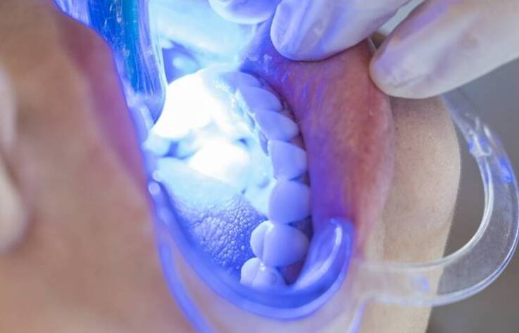 Czym jest wypełnienie światłoutwardzalne?