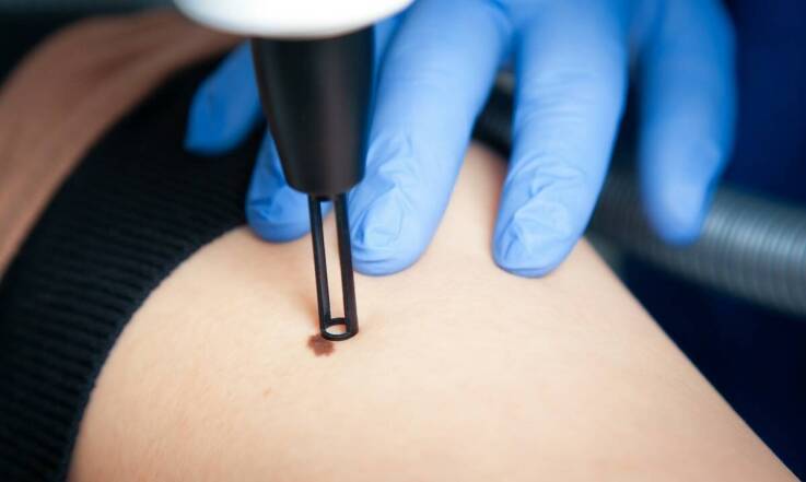 Zalety korzystania z profesjonalnych usług w zakresie usuwania włókniaków