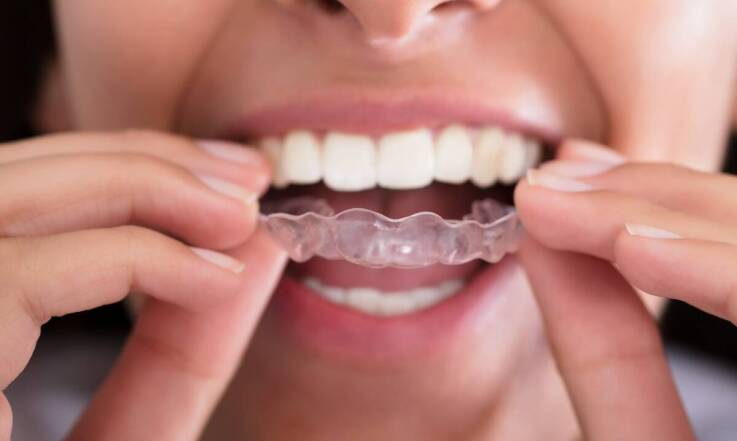 Jak invisalign pelplin może poprawić wymowę podczas leczenia?