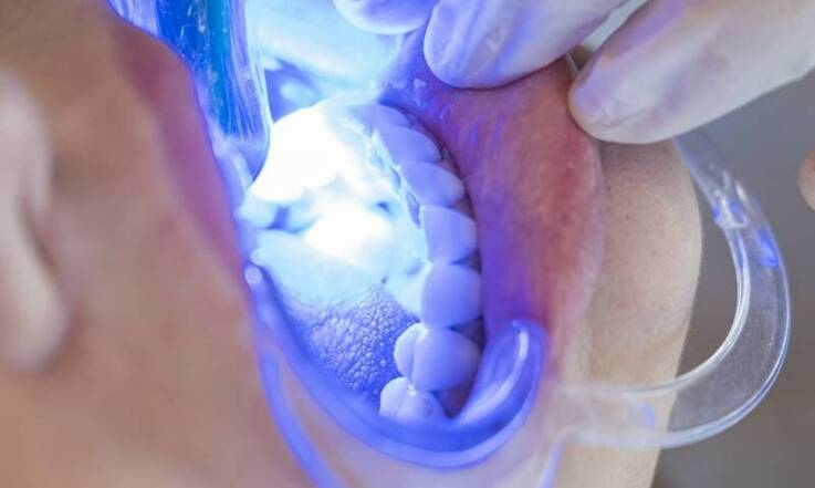 Jakie są najnowsze technologie stosowane przy zakładaniu licówek?