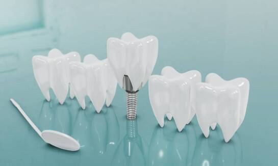 Holistyczne podejście do leczenia implantologicznego – korzyści dla pacjenta