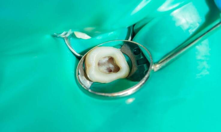 Dlaczego usuwanie kamienia nazębnego jest niezbędne dla zdrowia zębów?