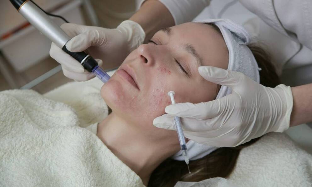 Jak mezoterapia igłowa wspomaga naturalne procesy odnowy skóry?