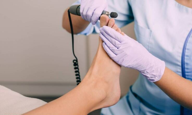 Jak usuwanie odcisków wpływa na zdrowie stóp?