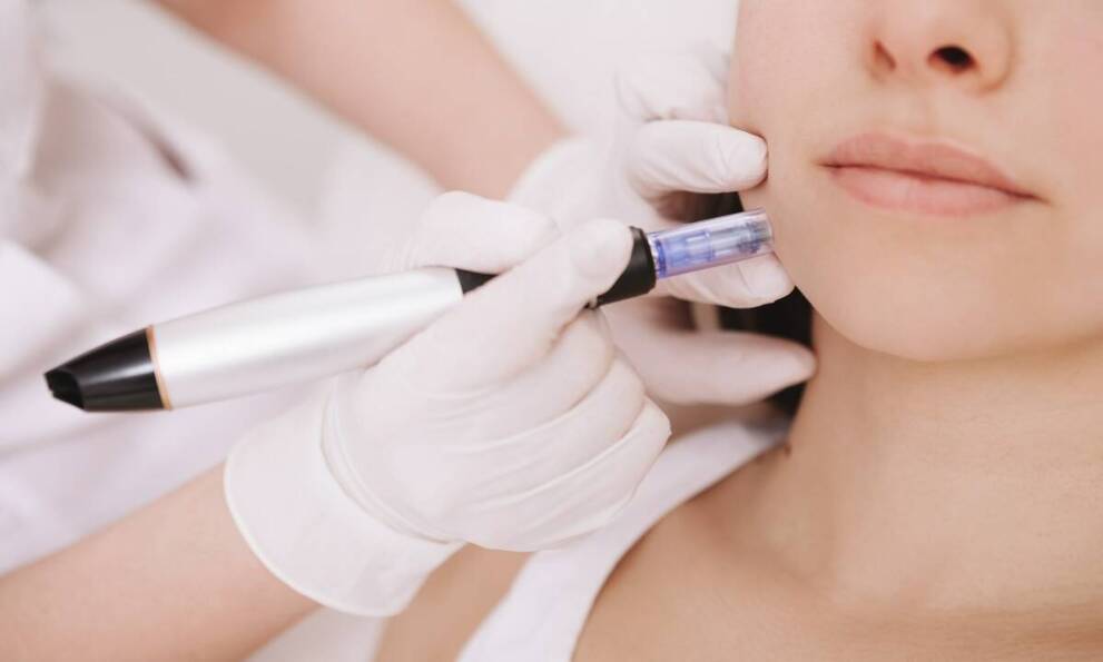 Innowacyjne techniki regeneracji skóry z użyciem Dermapenu
