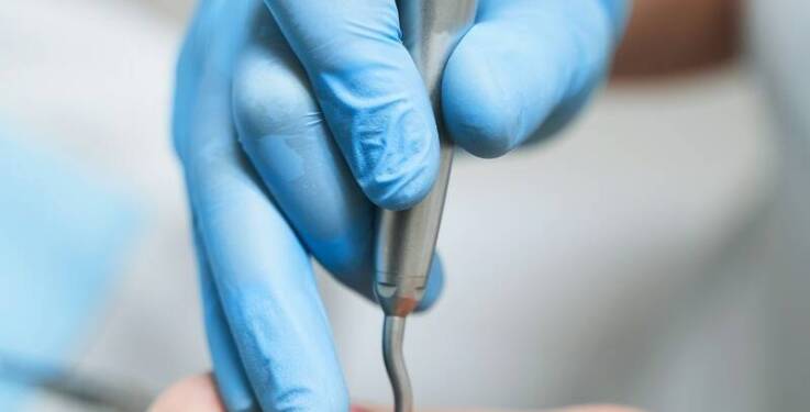 Jakie są kroki w zakładaniu koron zębowych?