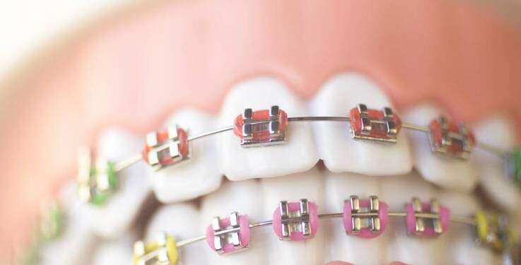 Jak długo trwa leczenie ortodontyczne?