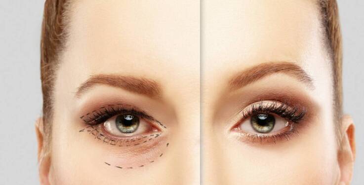 Bezpieczeństwo i efekty plastyki powiek – co gwarantuje sukces?