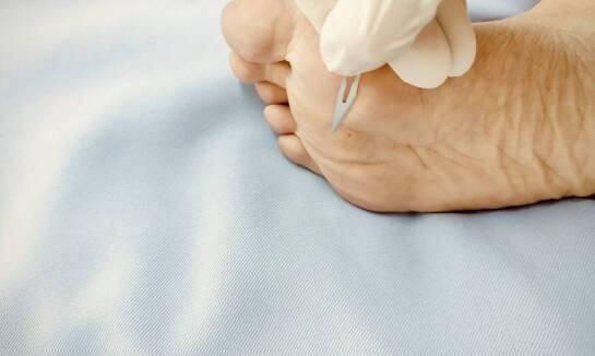 Usługi podologiczne a leczenie brodawek wirusowych na stopach