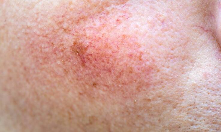 Jak trwale zlikwidować przebarwienia na twarzy?