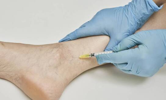 Klejenie żylaków: czy to właściwa metoda dla każdego pacjenta?