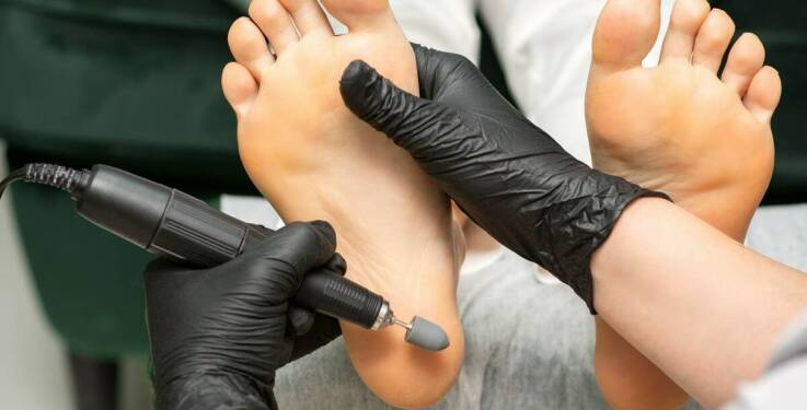 Efektywność technik pedicure w usuwaniu zrogowaciałego naskórka