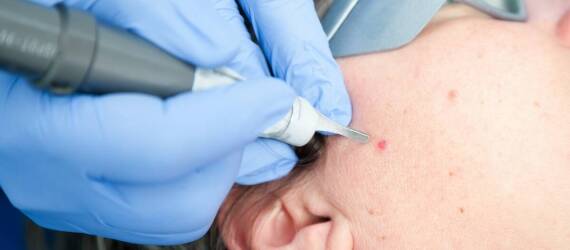 Jakie efekty można osiągnąć dzięki laserowi CO2 w medycynie estetycznej?