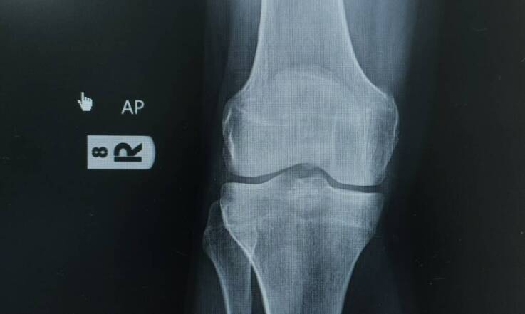 Kwas hialuronowy na kolano: jakie są potencjalne skutki uboczne?